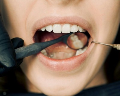 Búcsú a fogkőtől: a fogkő eltávolítása fájdalommentesen!